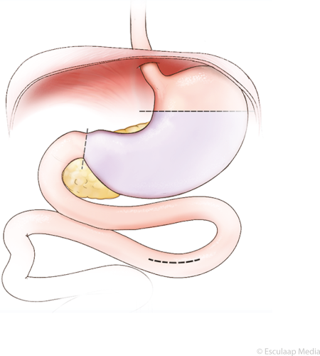 Gedeeltelijke maagverwijdering voor