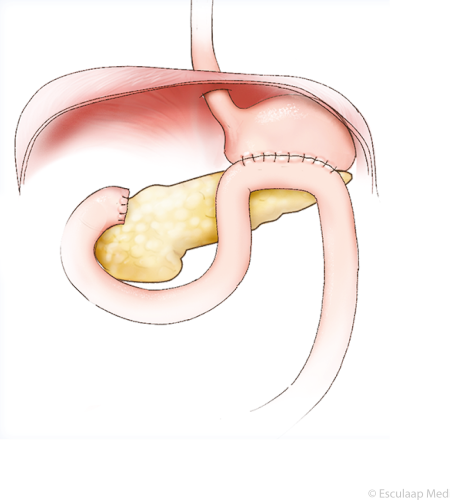 Gedeeltelijke maagverwijdering na