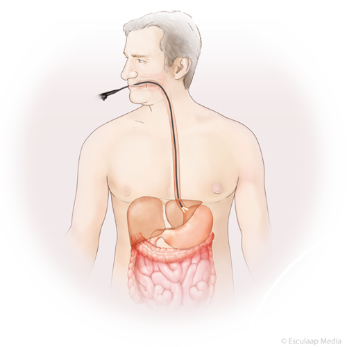 Maagkanker diagnostiek endoscopische echografie