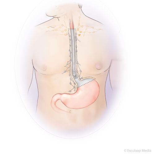 Slokdarmkanker operatie voor